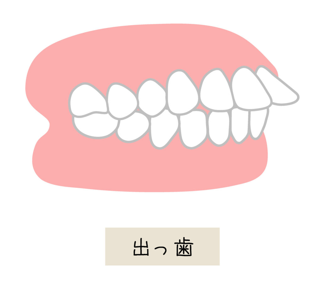 出っ歯（上顎前突）