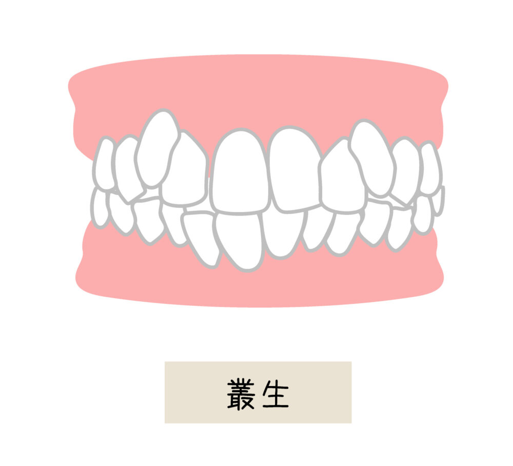 歯並びがデコボコ（叢生）