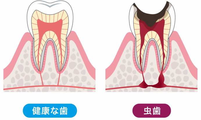 むし歯とは