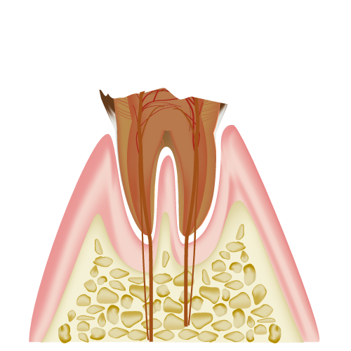 C4（見えている部分の歯の大部分が失われた状態）