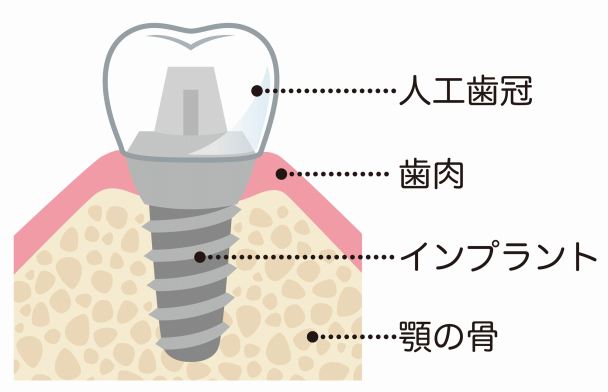 インプラントの構造