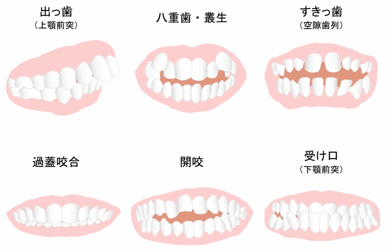 不正咬合について