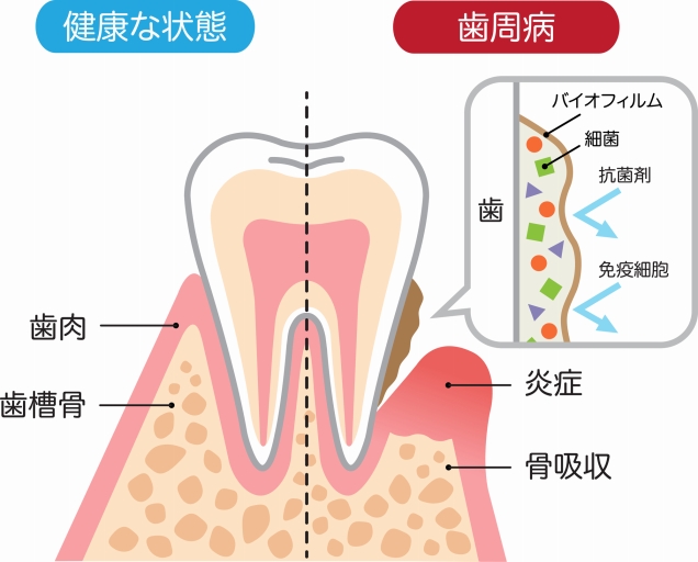 歯周病とは