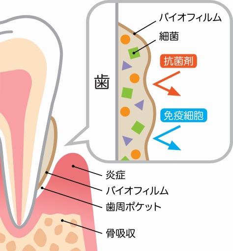 歯周病の原因