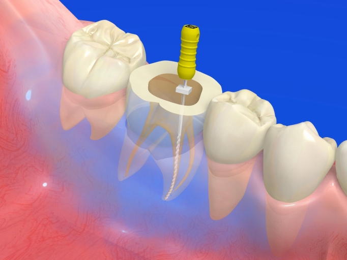 根管治療（歯の根の治療）