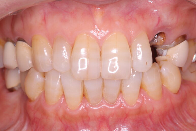 前歯のインプラント治療 術前