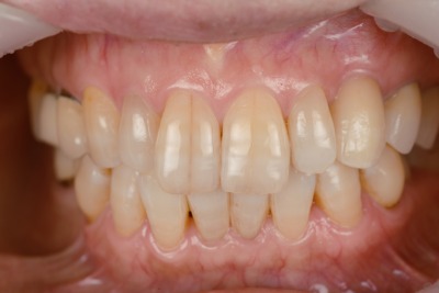 前歯のインプラント治療 術後