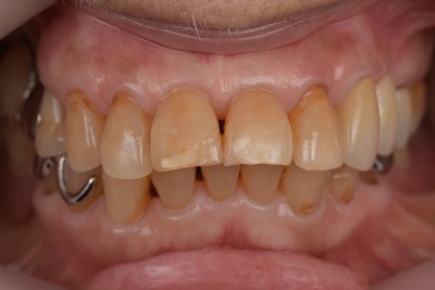 出っ歯の審美歯科治療　術前
