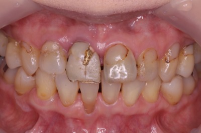 前歯のすきっ歯 審美歯科治療 術前