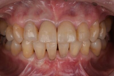 前歯のすきっ歯 審美歯科治療 術後