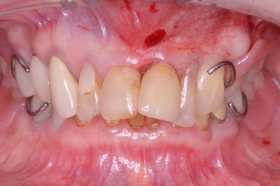 歯がグラグラ 審美歯科治療 術前